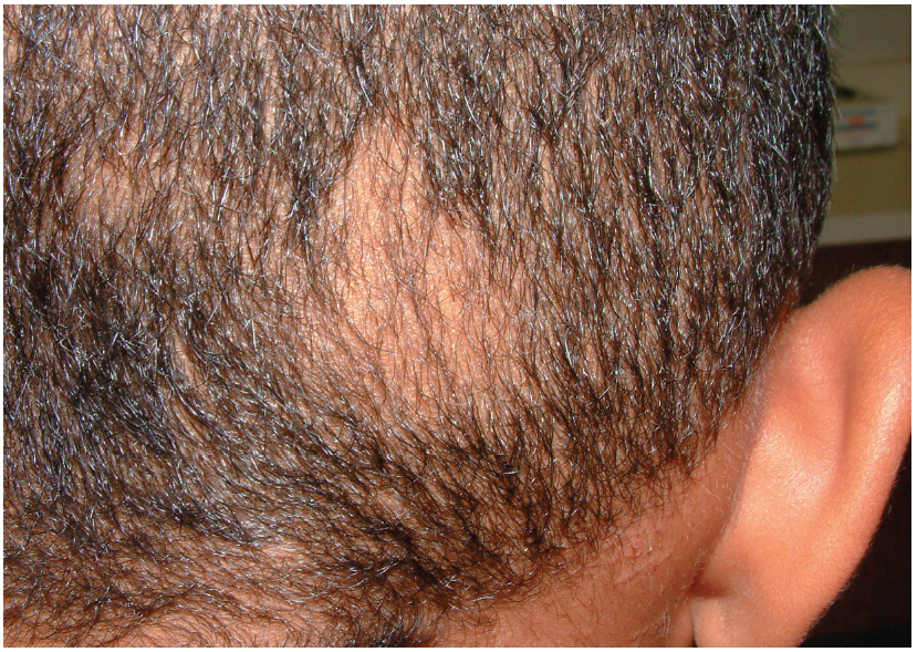 Trichotillomania Consultant360